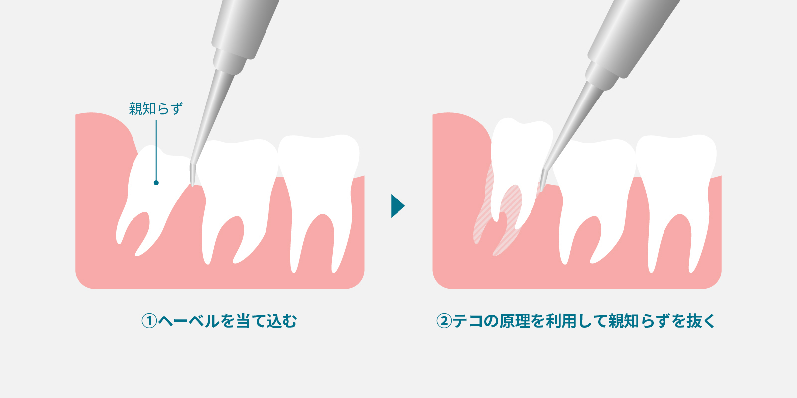 正常な（通常の）親知らずの抜歯方法