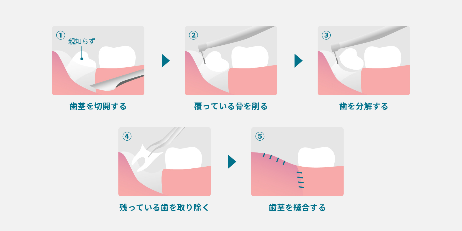 歯茎の中に埋まっている親知らずの抜歯方法