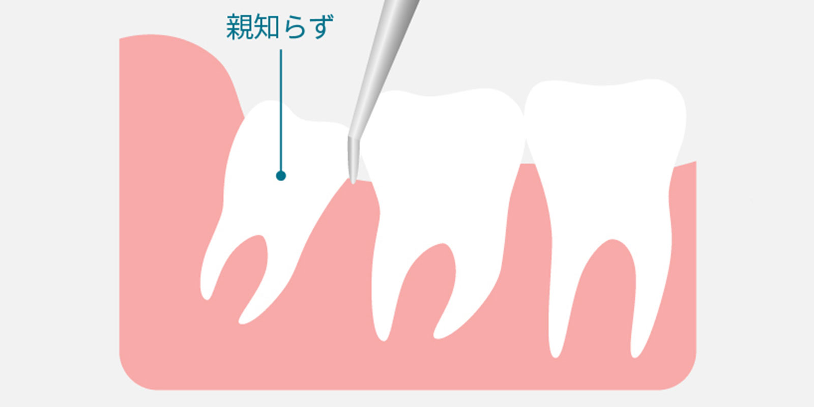 正常な（通常の）親知らずの抜歯方法